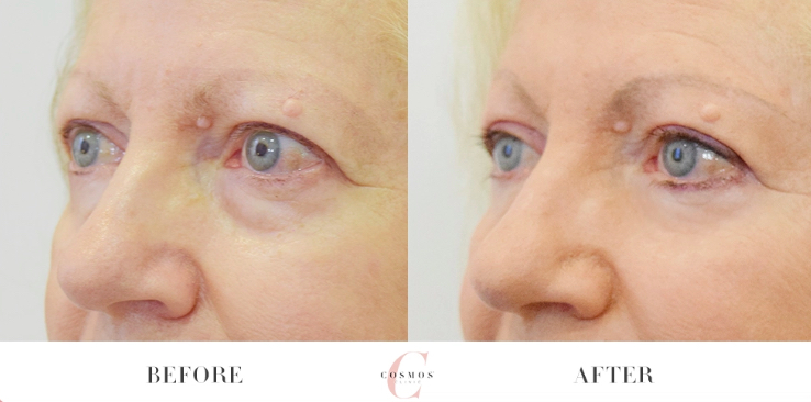 non-surgical eyelid lift treatment