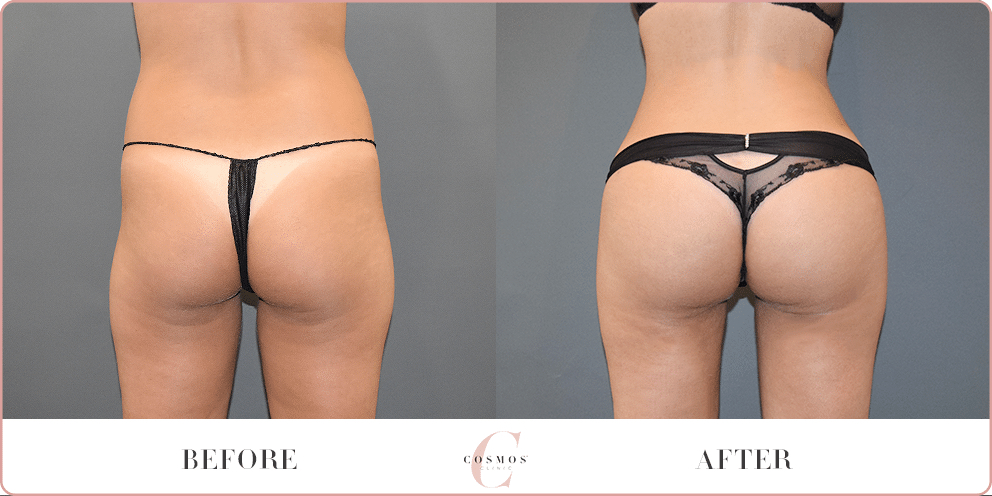 Brazilian Butt Lift