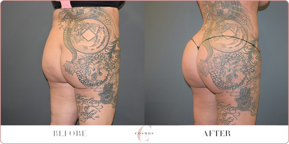 Brazilian Butt Lift