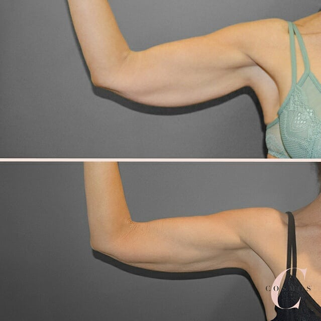 What Liposuction Can and Can’t Achieve