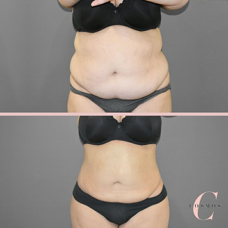 tummy transformation