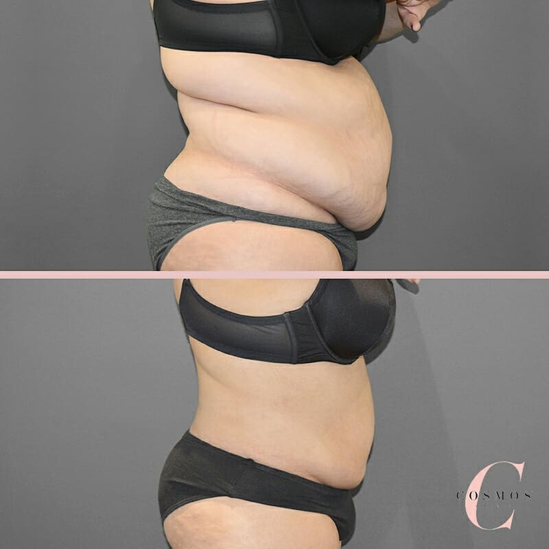 tummy transformation