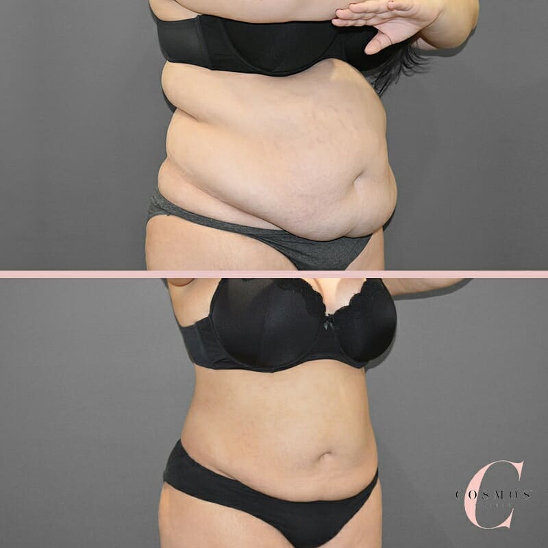 tummy transformation