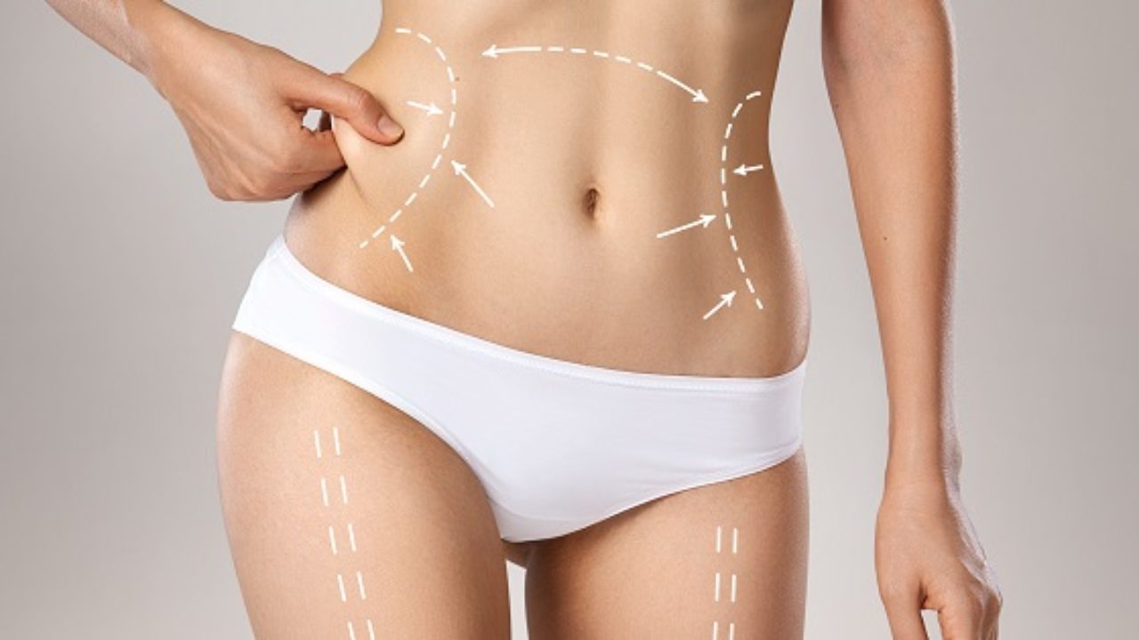 What Liposuction Can and Can't Achieve