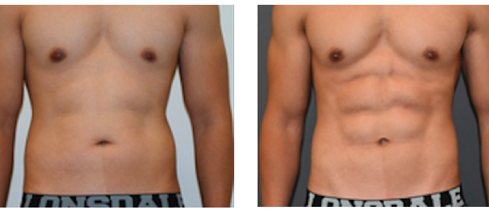 Before & After of male Vaser High Definition Liposuction Surgery via Dr Joseph Ajaka’s Real Self Profile