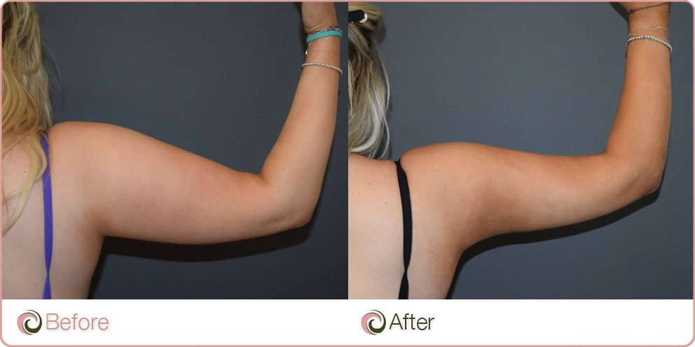 Before and After - Liposuction to the arms