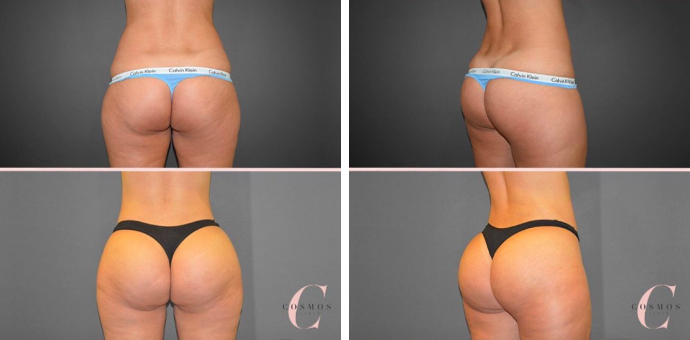 BBL Beyoncé Before and After