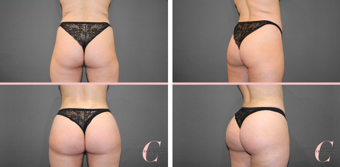 BBL Beyoncé Before and After