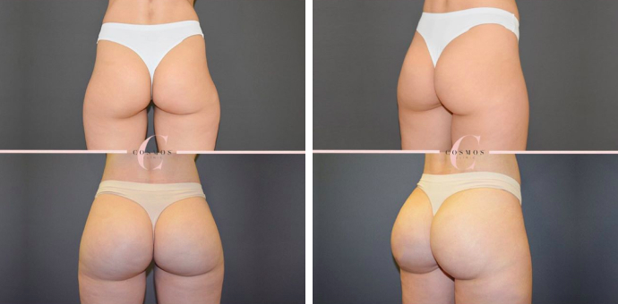 BBL Kim Kardashian Before and After