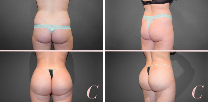 BBL Kim Kardashian Before and After