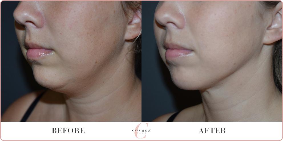 Before and After - Liposuction to the neck