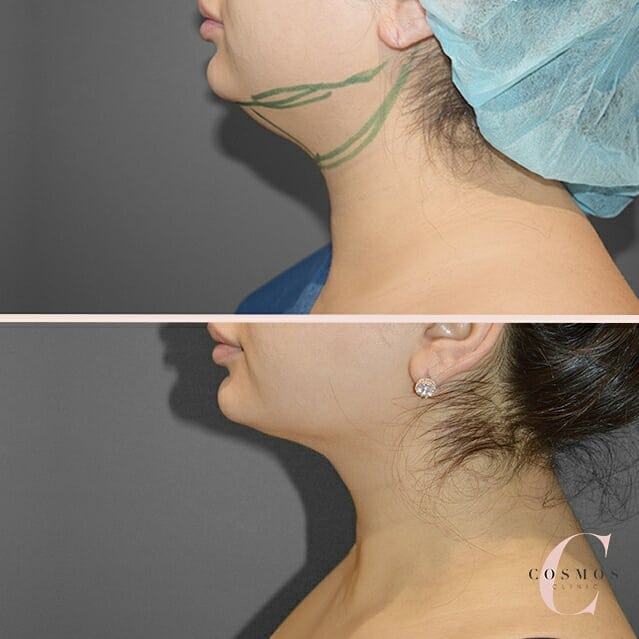 Before and After of Neck Liposuction as seen on our Instagram Feed