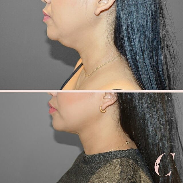 Before and After of Neck Liposuction as seen here on Cosmos Clinic's Instagram Feed