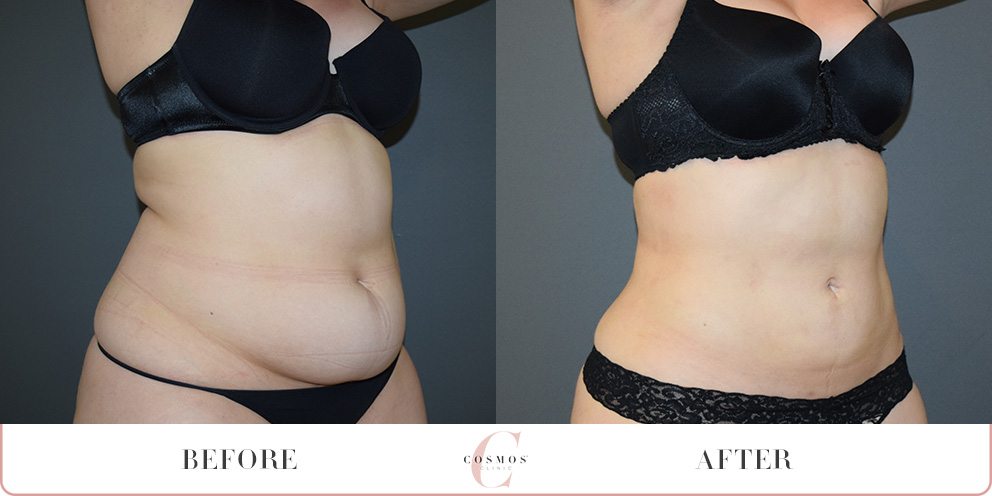 Before and After - Liposuction to the tummy region