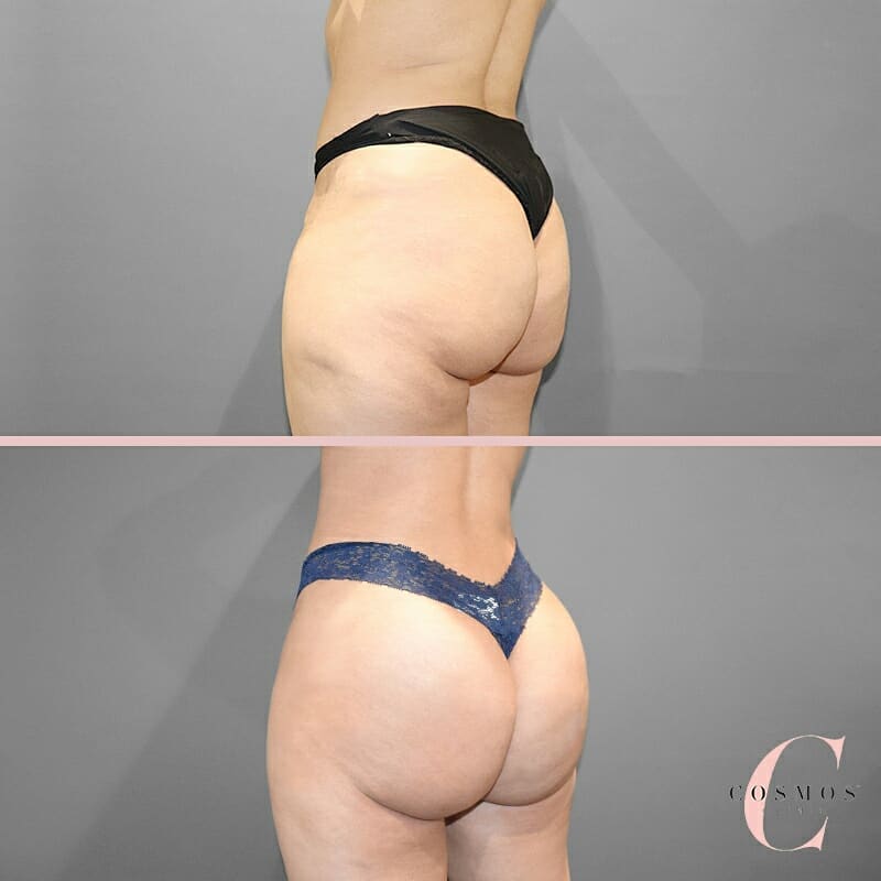 A recent BBL showing how the procedure can be used to enhance the shape and create perfect proportions