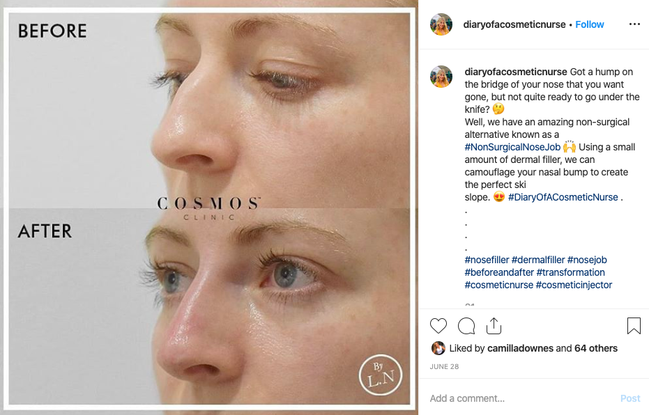 non-surgical nose job