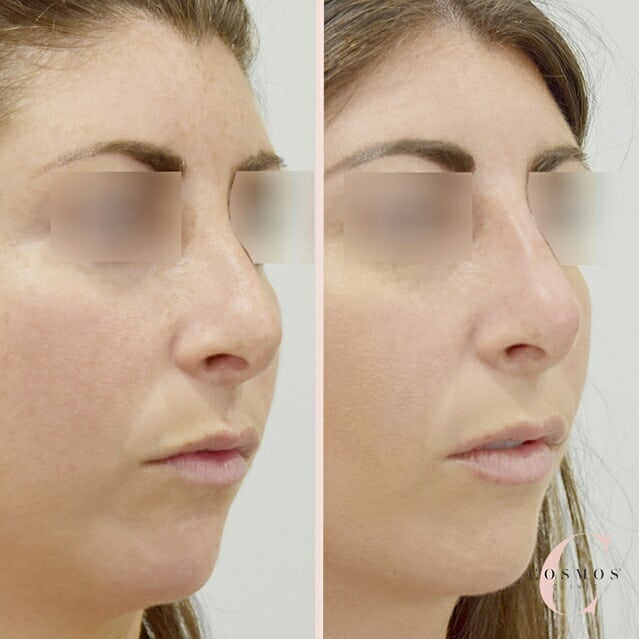 non-surgical nose job