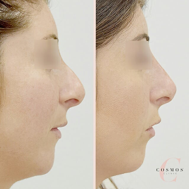 non-surgical nose job