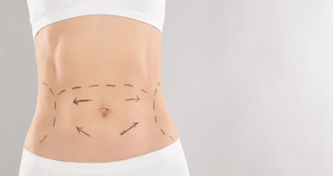 What Are the Real Side Effects of CoolSculpting on the Gold Coast?