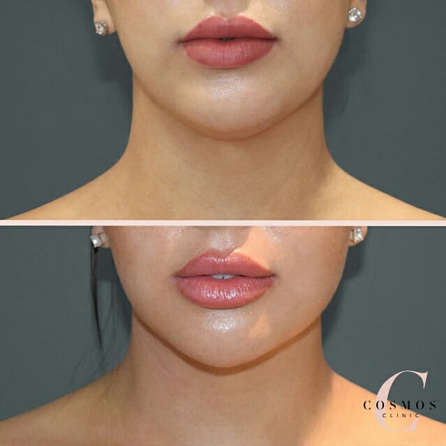 Neck liposuction, patient 02 before & after