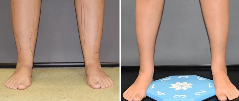 ankle calf ankles coolsculpting liposuction female pre2024 001 before and after before and after