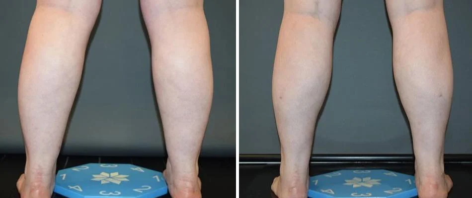 ankle calf coolsculpting liposuction female pre2024 002 before and after before and after