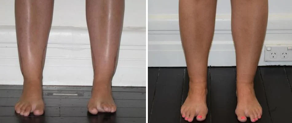 ankle calf liposuction female pre2024 006 before and after before and after
