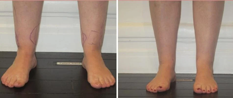 ankle calf liposuction female pre2024 007 before and after before and after