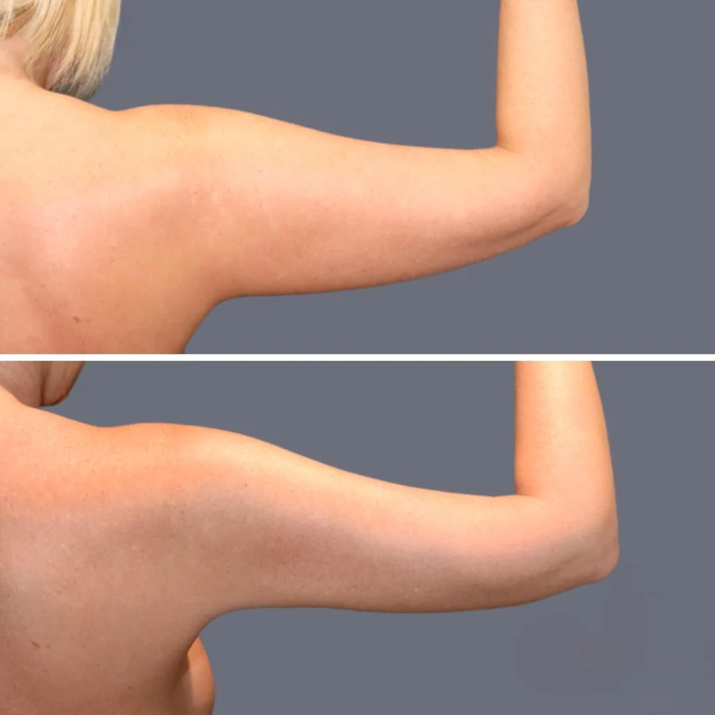 arm liposcution pre2024 001 before and after before and after