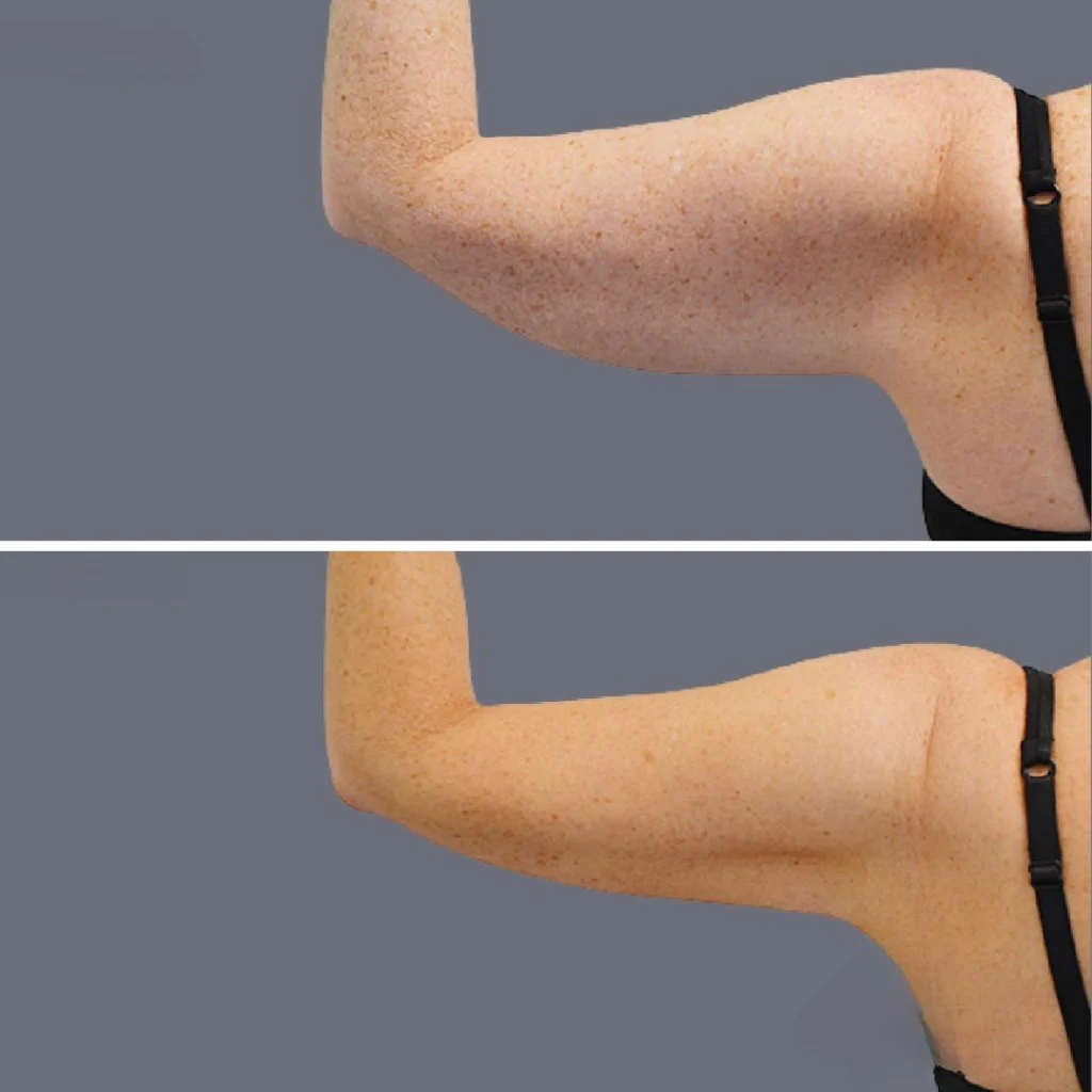 arm liposcution pre2024 003 before and after before and after