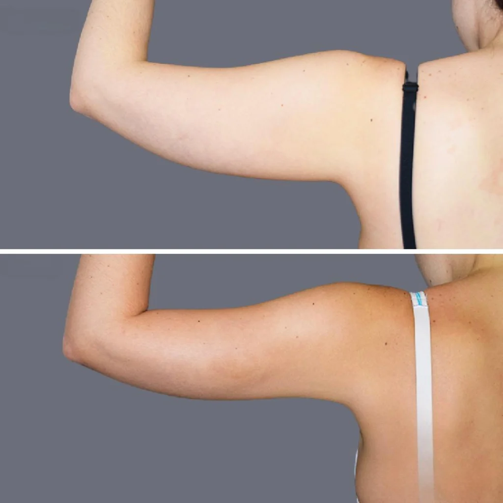 arm liposcution pre2024 004 before and after before and after