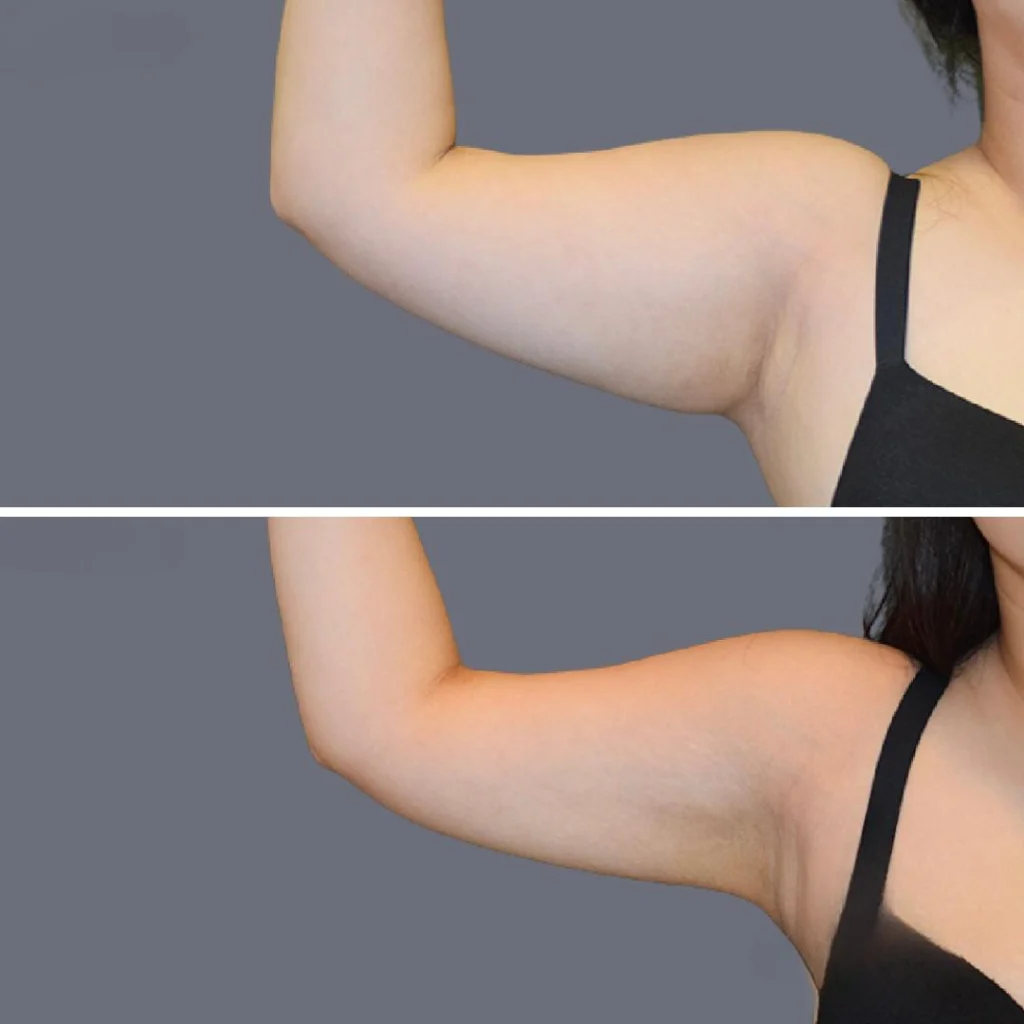 arm liposcution pre2024 005 before and after before and after