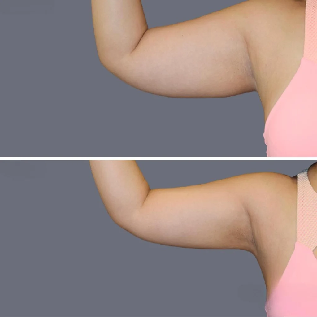arm liposcution pre2024 007 before and after before and after