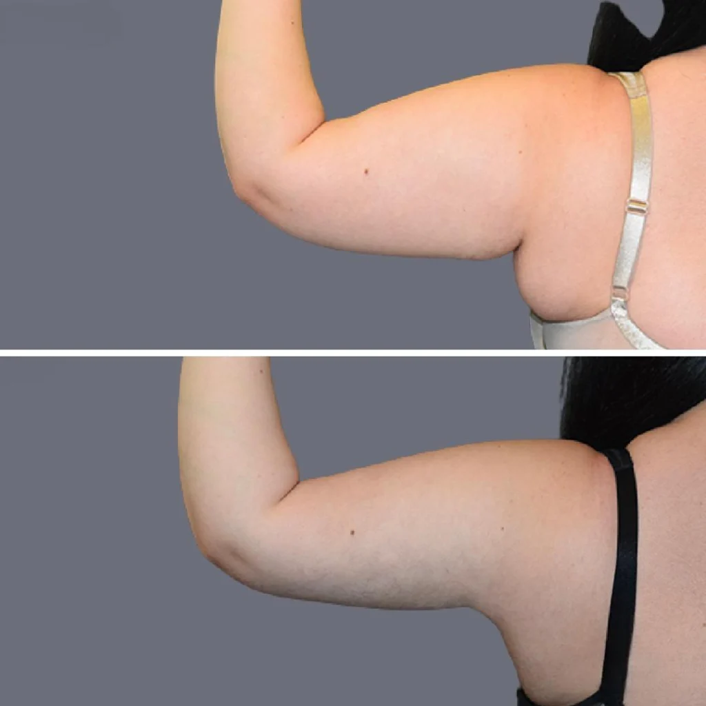 arm liposcution pre2024 008 before and after before and after