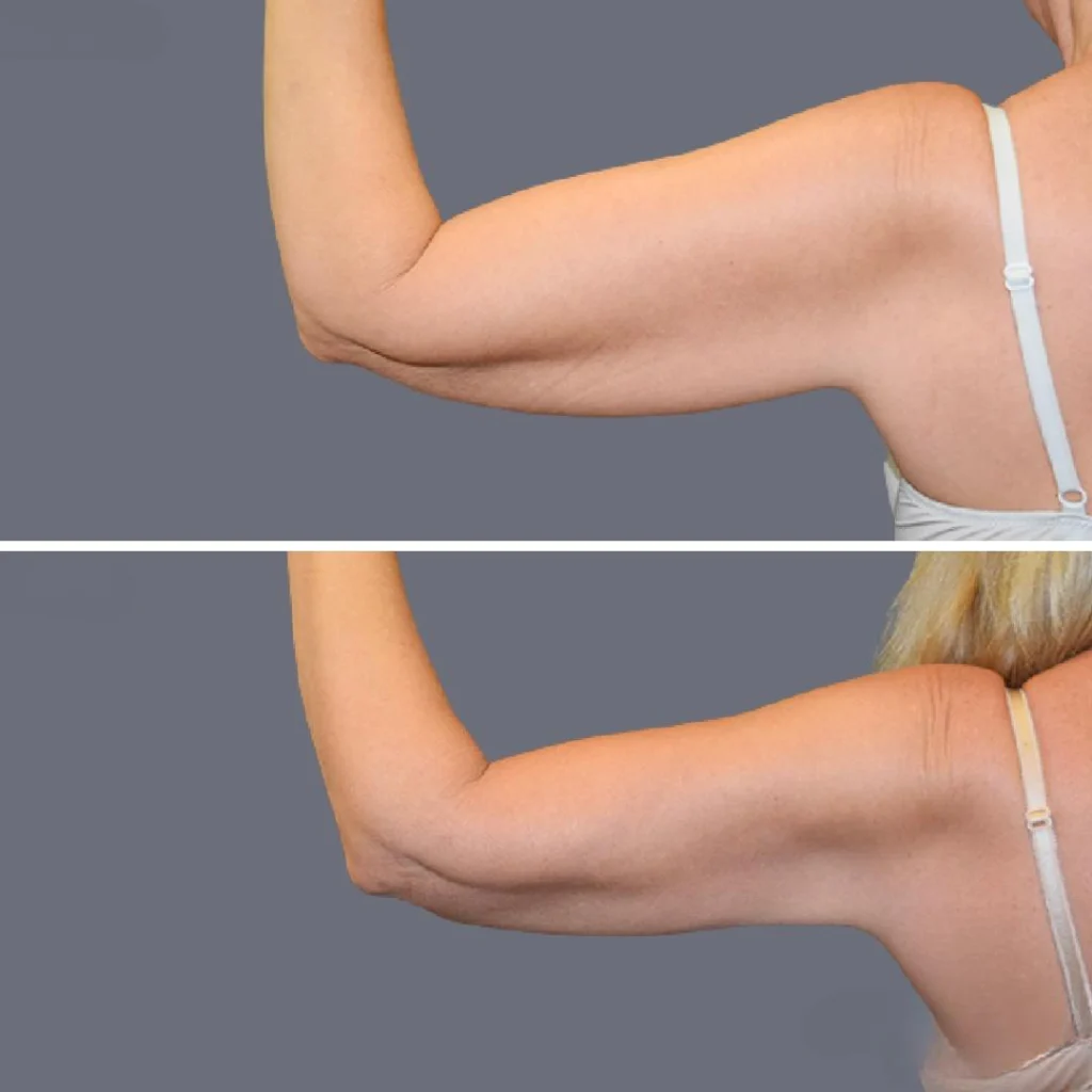 arm liposcution pre2024 010 before and after before and after