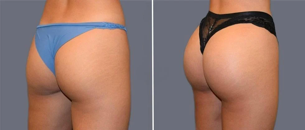 brazilian butt lift pre2024 001 before and after before and after