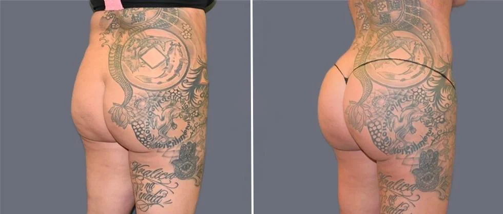 brazilian butt lift pre2024 002 before and after before and after