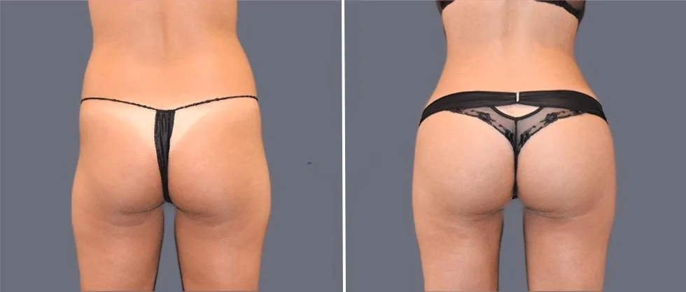 Before and after bbl brazilian butt lift of the buttocks.
