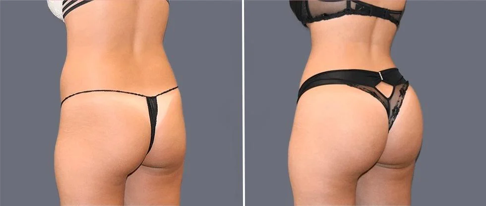 brazilian butt lift pre2024 006 before and after before and after
