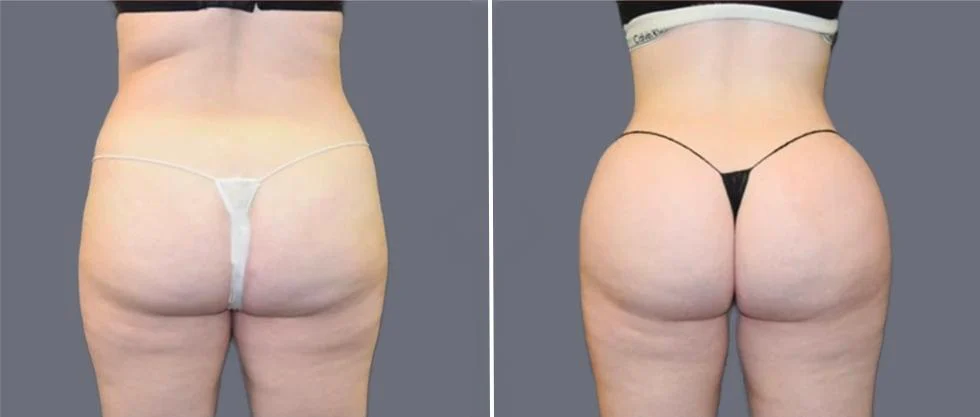 brazilian butt lift pre2024 008 before and after before and after
