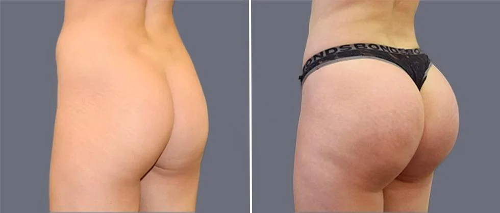 brazilian butt lift pre2024 010 before and after before and after