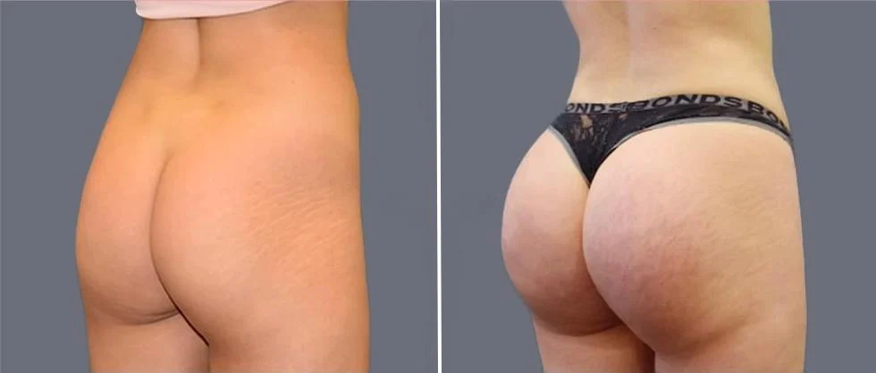 brazilian butt lift pre2024 012 before and after before and after