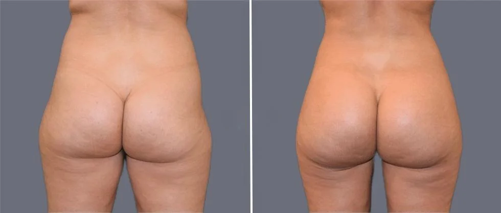 brazilian butt lift pre2024 015 before and after before and after