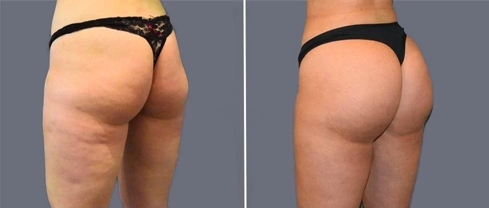 brazilian butt lift pre2024 016 before and after before and after