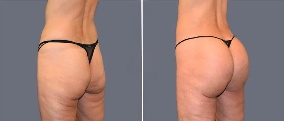 brazilian butt lift pre2024 019 before and after before and after