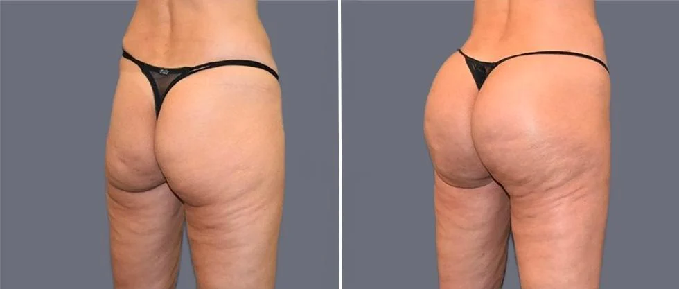 brazilian butt lift pre2024 020 before and after before and after