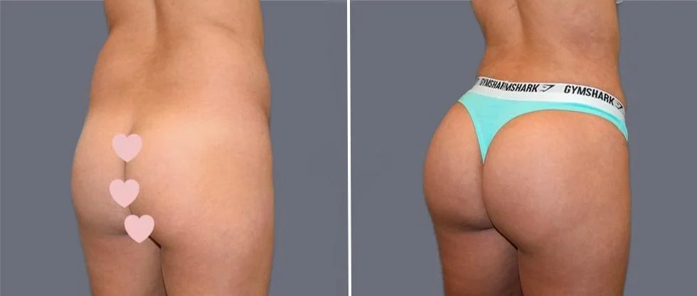 brazilian butt lift pre2024 022 before and after before and after