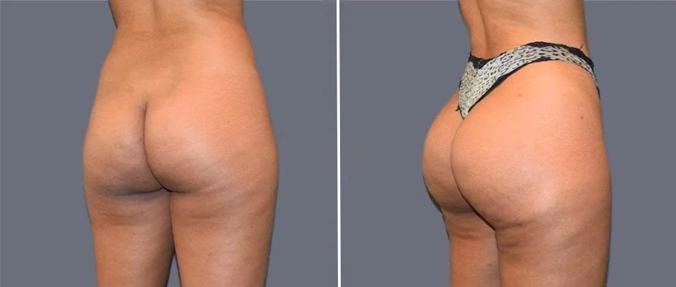 brazilian butt lift pre2024 023 before and after before and after