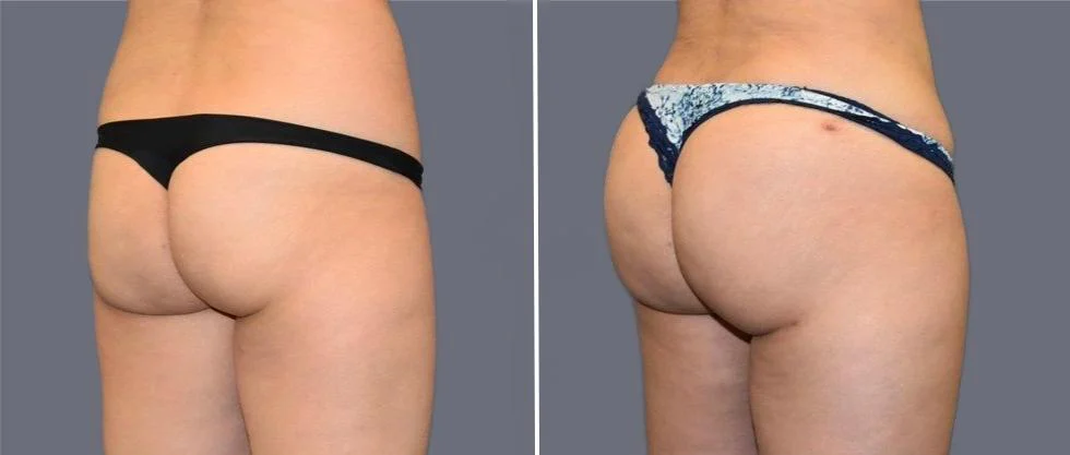 brazilian butt lift pre2024 024 before and after before and after