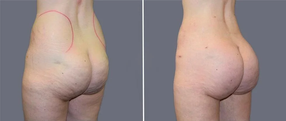 brazilian butt lift pre2024 028 before and after before and after
